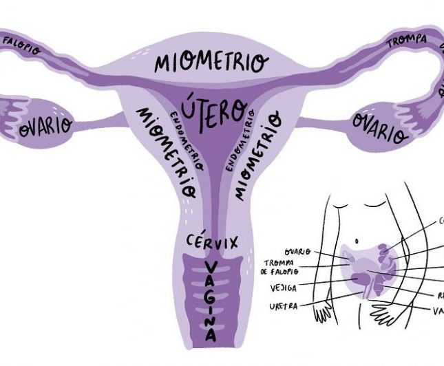 endometriosis